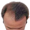 Korektory proti vypadávání vlasů